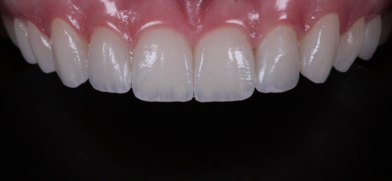Lente de contato dental em porcelana